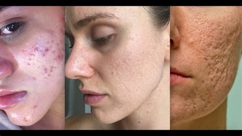 5 Types of Acne Scars and How to Treat Them